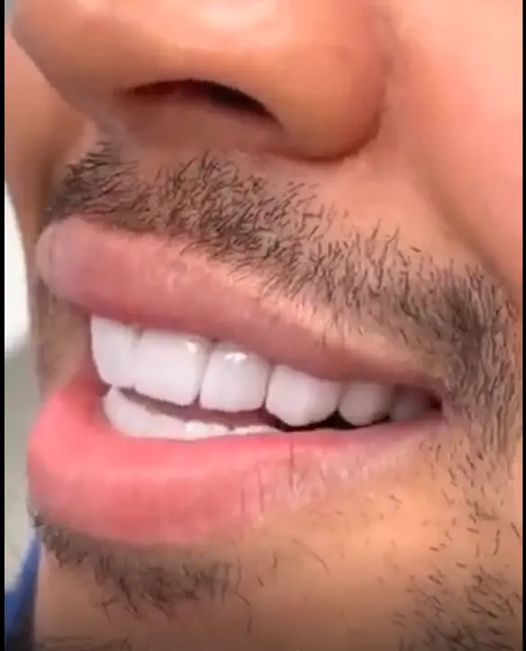 Dental Veneers