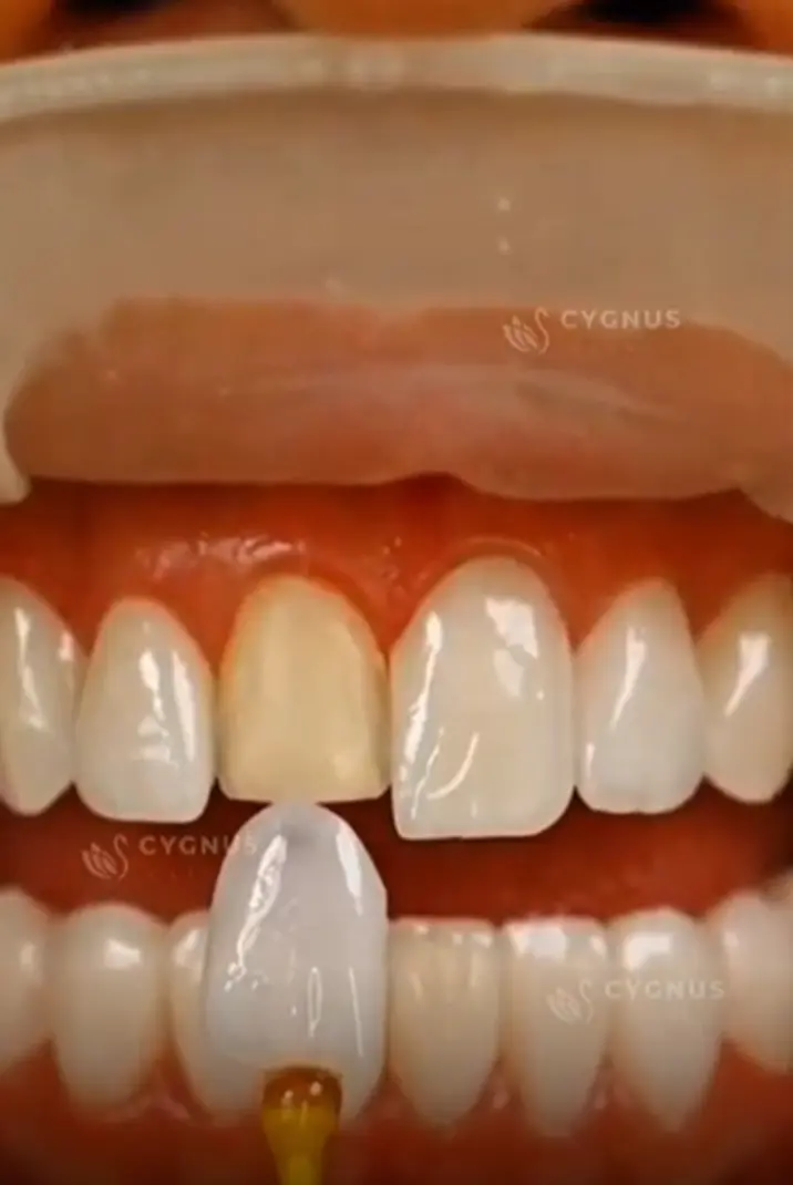 Smile Design (Hollywood Smile) cygnus